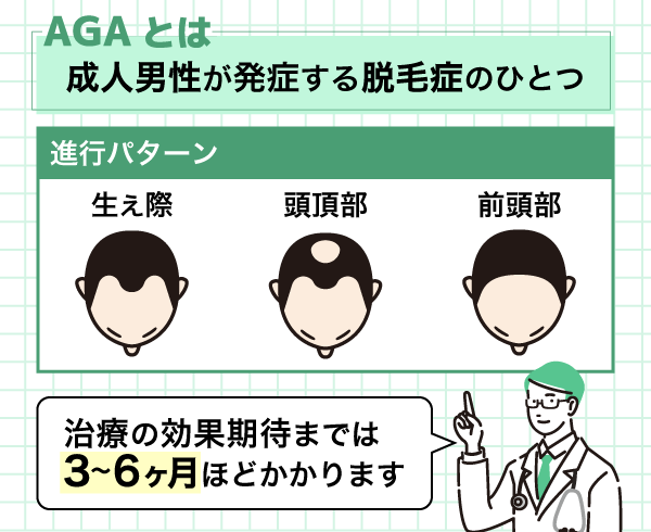 AGAの進行パターンを説明した図